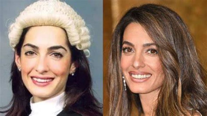 Amal Clooney Plastic Surgery | Before And After Photos