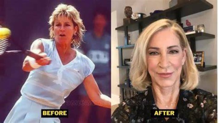 
What Illness Does Chris Evert Have? Fans Worried About Her Health 